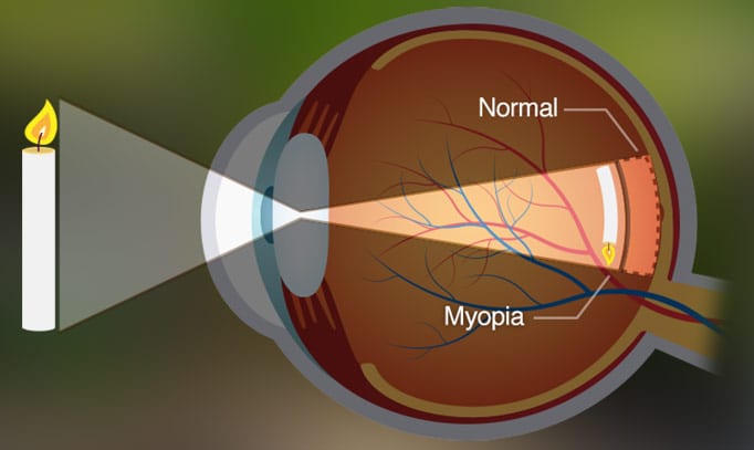 Graphic of structure of an eye depicting visual errors