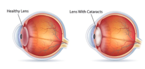 Difference between healthy lens and cataracts graphic